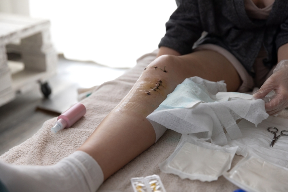 ACL Reconstruction for Amateur Athletes Returning to Local Footy and Netball