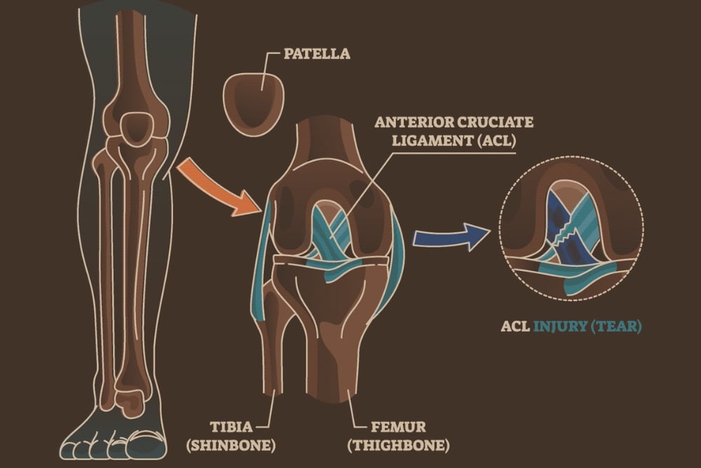 What ACL Reconstruction Aims to Achieve
