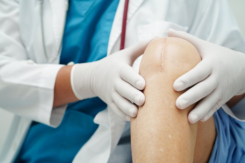 A Realistic Knee Replacement Recovery Timeline